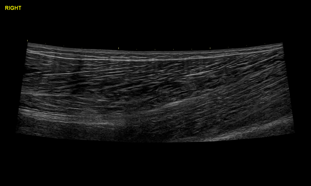 Ultrasound of the right biceps femoris long head